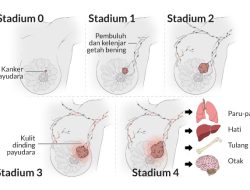 Kanker Payudara Dapat Disembuhkan Bila Terdeteksi di Stadium Awal